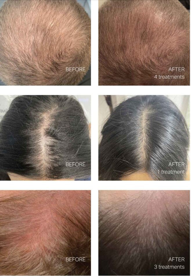 Keravive Scalp Treatment